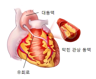 대동맥 막힌광상동맥 및 우회로의 대한 예시