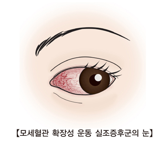 모세혈관 확장성 운동 실조증후군의 눈의 예시