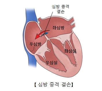 심방중격결손-우심방,좌심방,우심실,좌심실 위치 그림 예시