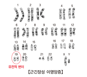 1번부터22번및X,Y염색체중 19번염색체가 근긴장성 이영양증에의해 유전적 변이를 하였음