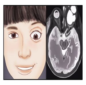 왼쪽눈이 안구돌층증이나타난 여자아이(왼쪽),여자아이의 CT사진(오른쪽)