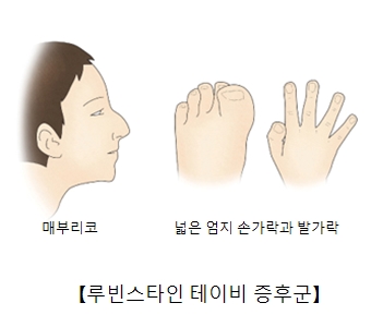 루빈스타인테이비증후군-매부리코,넓은엄지손가락과발가락 그림 예시