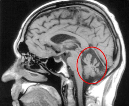 척수소뇌성 운동실조증에 걸린 사람의 CT사진