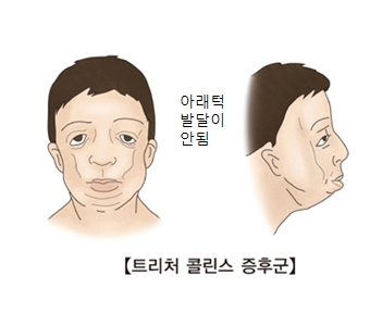 트리처 콜린스 증후군- 아래턱 발달이 안된 남성 그림 예시