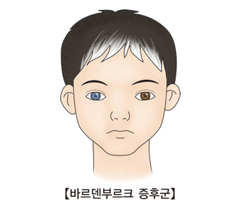 청력장애와 피부와 머리카락, 눈의 색소변화 등을 특징보이는 남자아이
