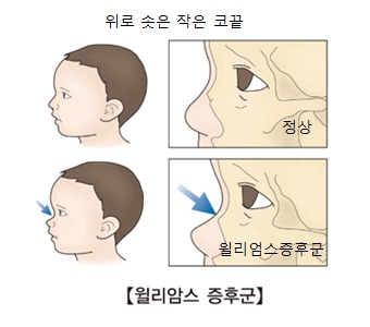 정상아이의 코끝과 윌리암스증후군을 가진 아이의 코끝 그림 예시