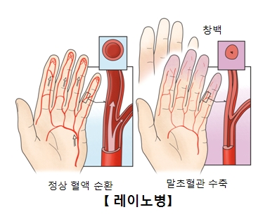 레노이병-정상혈액순환사진예시(왼쪽),말초혈관수축되손이창백해진 사진예시(오른쪽)