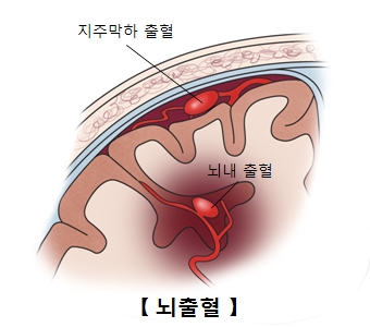 뇌출혈-지주막하출혈과 뇌내출혈 사진 예시