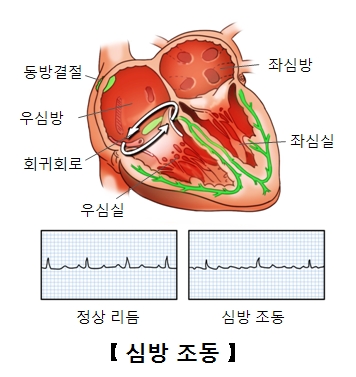 좌심방 좌심실 우심실 회귀회로 우심방 동방결절 위치 및 정상리듬 과 심방조동의 예시