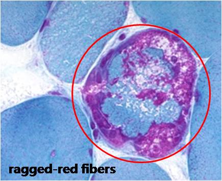 MERRF(Myoclonic Epilepsy with Ragged Red Fiber) 증후군