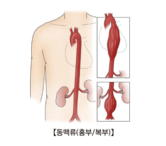 대동맥류