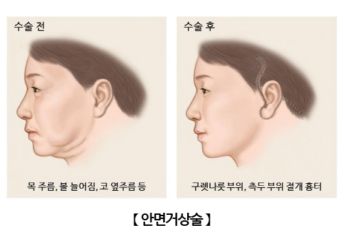 안면거상술