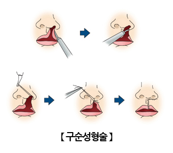 구순성형술