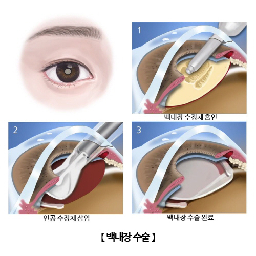 백내장 수술