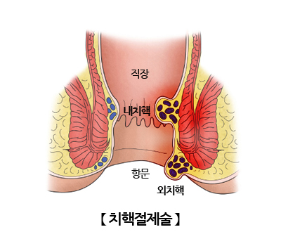 치핵절제술