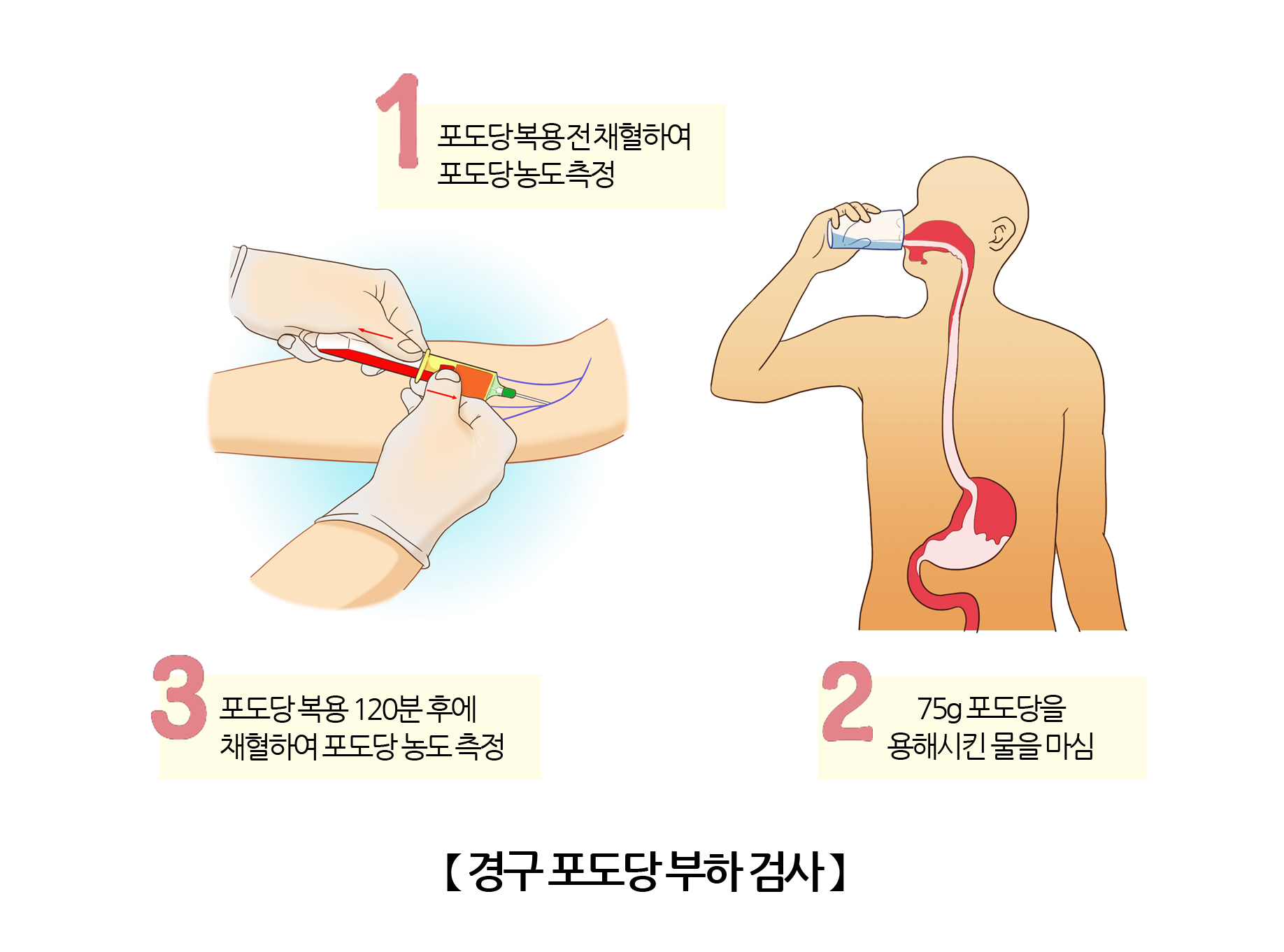 경구 포도당 부하 검사