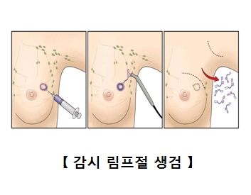 감시 림프절 생검