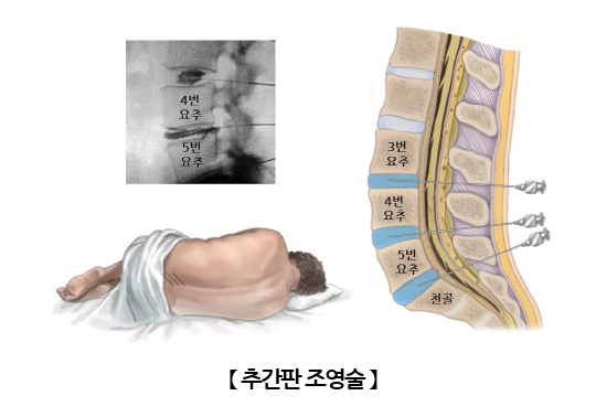 추간판 조영술