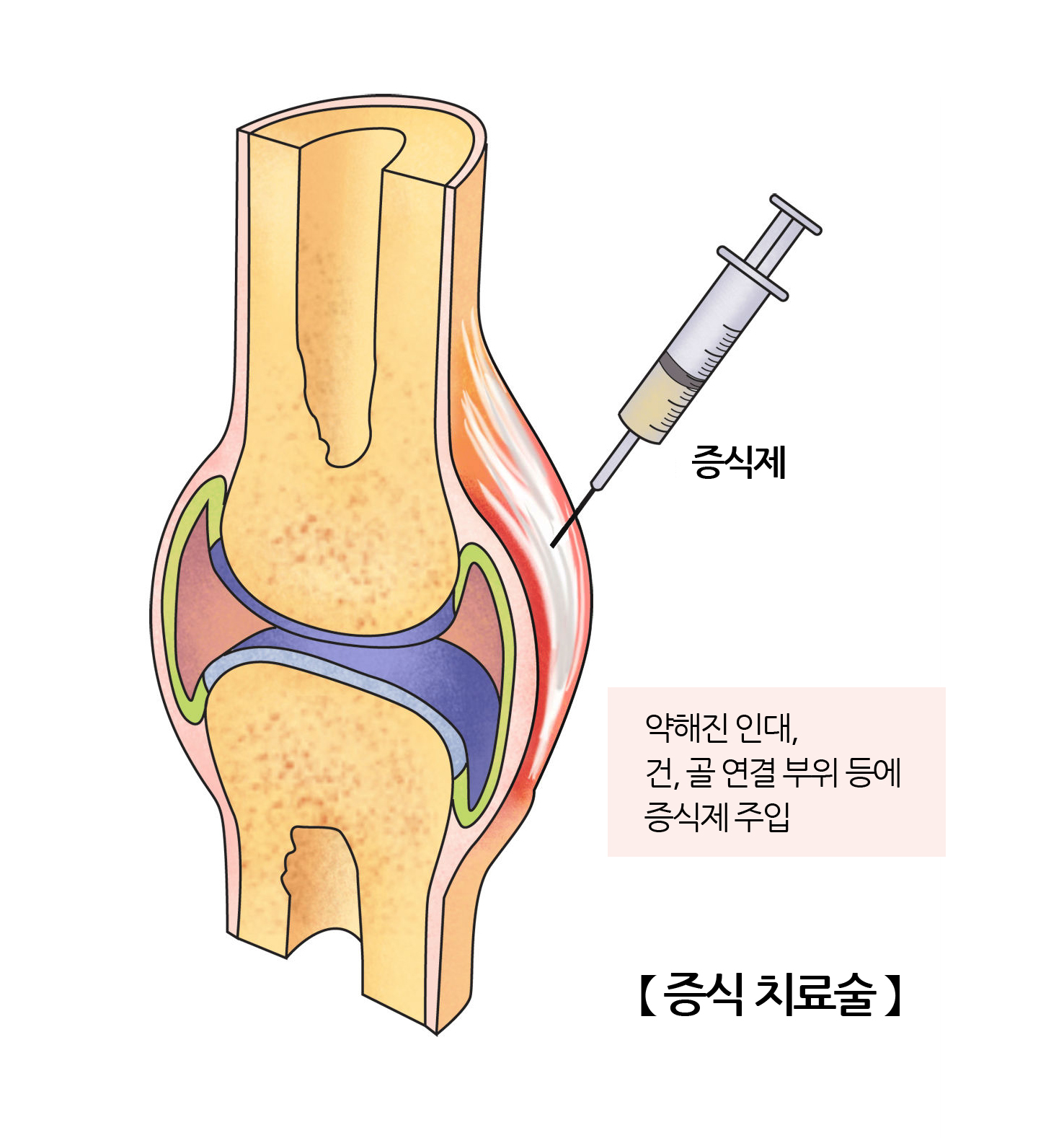 증식 치료술