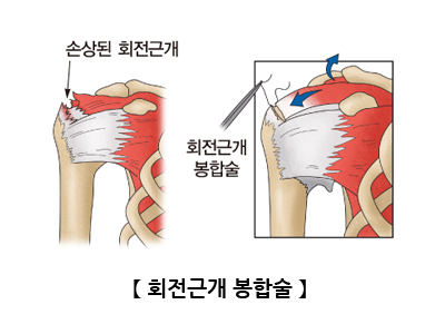 회전근개 봉합술