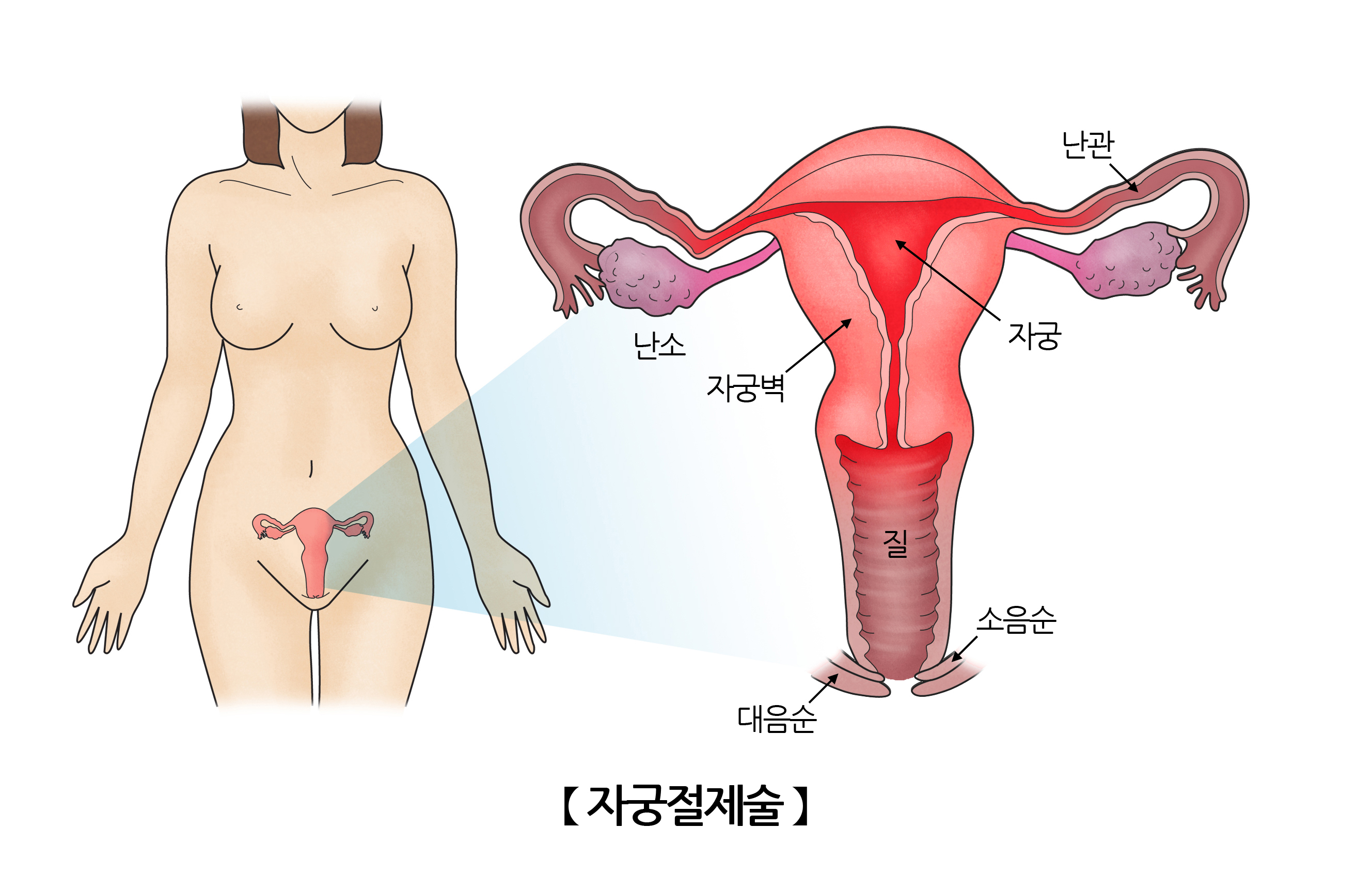 자궁절제술