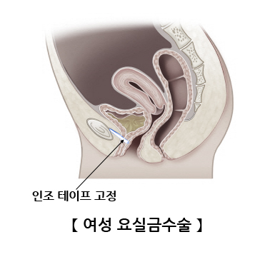 여성 요실금수술