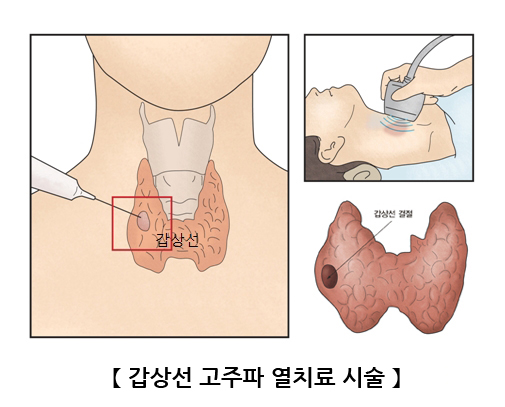 갑상선 고주파 열치료 시술