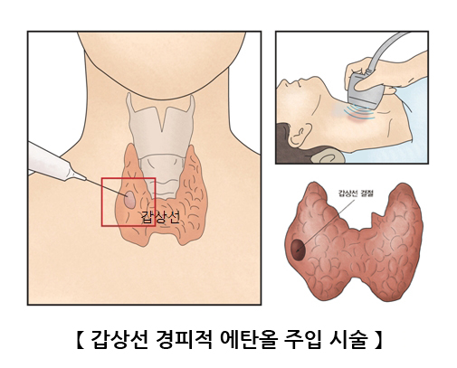 갑상선 경파적 에탄올 주입 시술