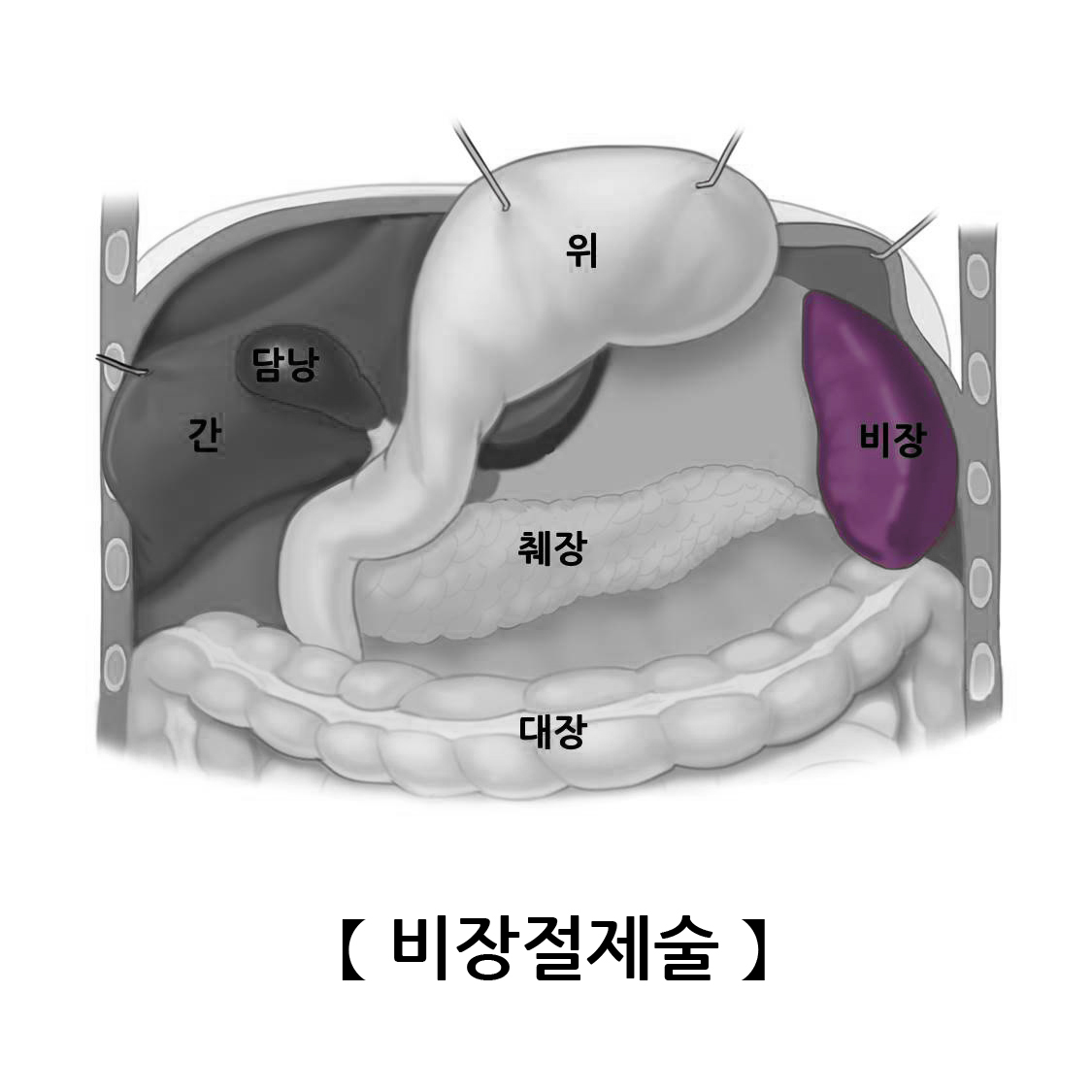 비장절제술