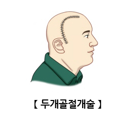 두개골절개술