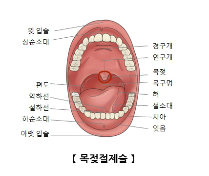 목젖절제술