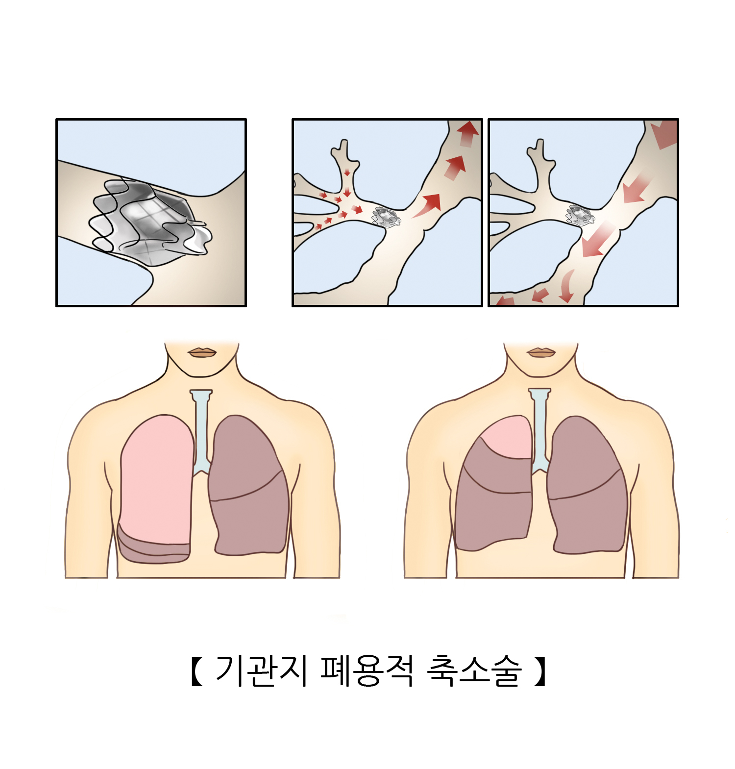 기관지 폐용적 축소술