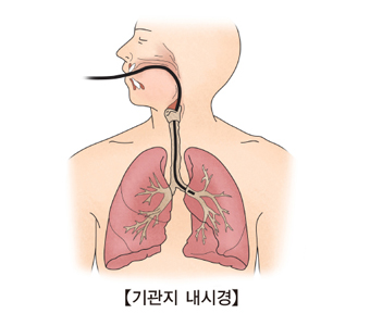 기관지 내시경