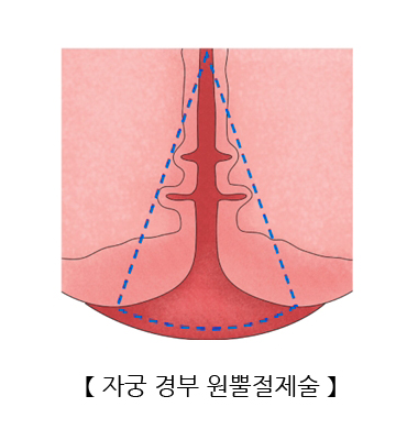 자궁 경부 원뿔절제술