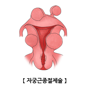 자궁근종절제술