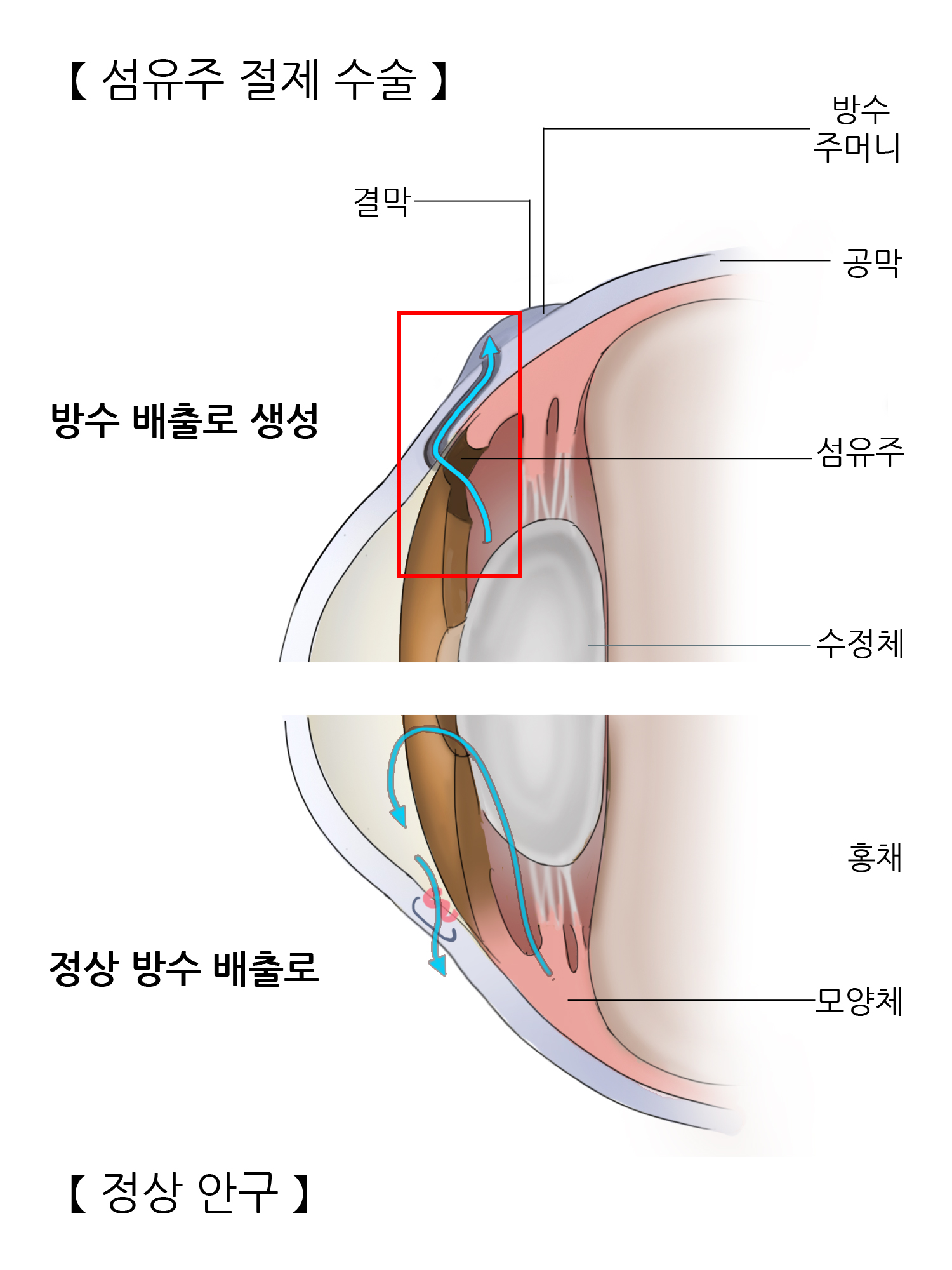 섬유주 절제 수술