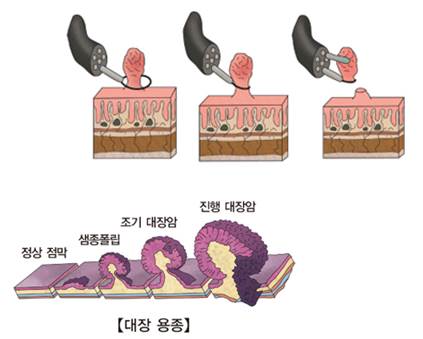 대장폴립절제술