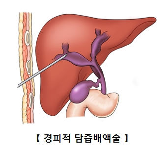 경피적 담즙배액술