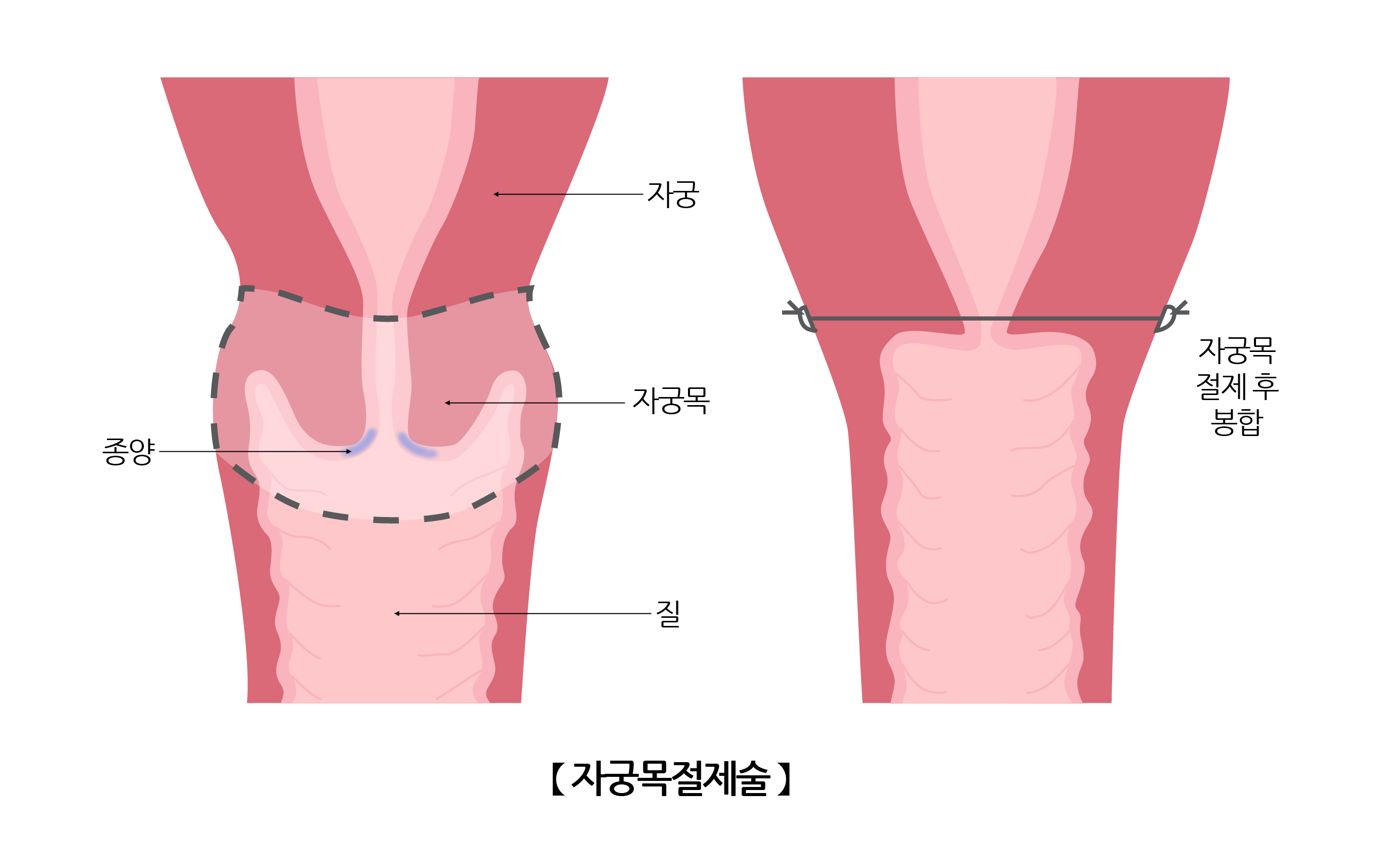 자궁목절제술