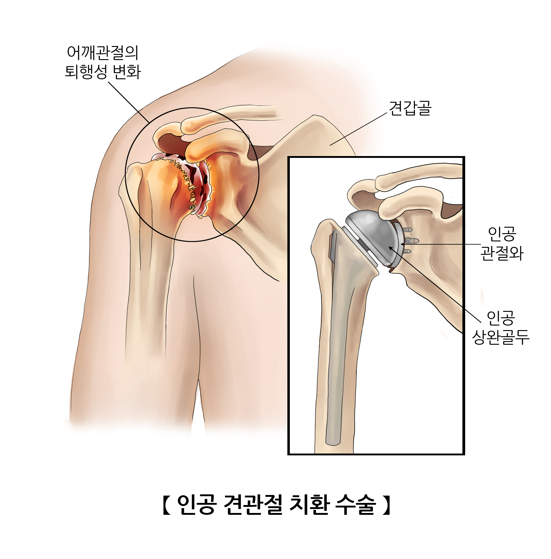 인공 견관절 치환 수술