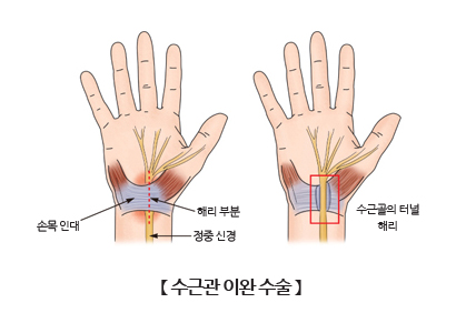 수근관 이완 수술