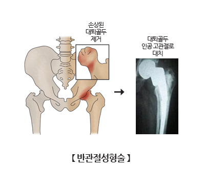 반관절성형술