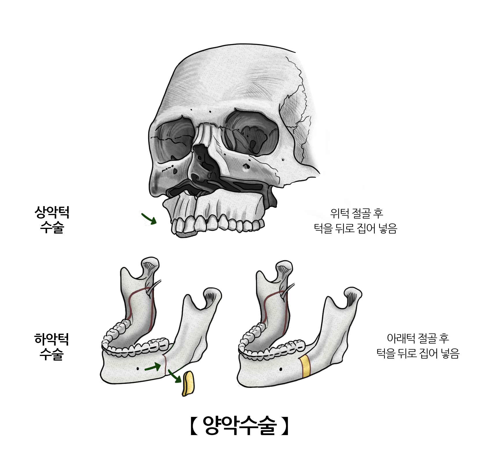 양악수술