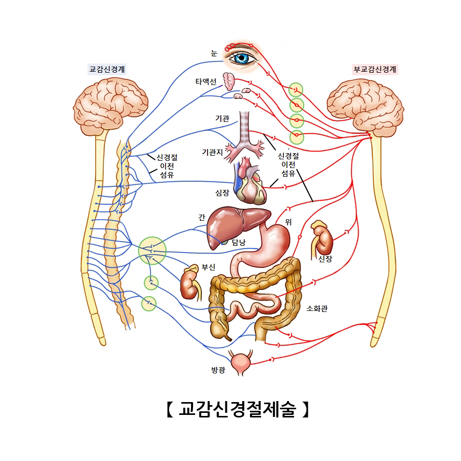 교감신경절제술