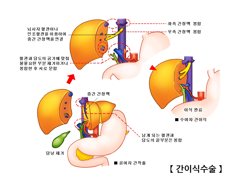 간이식수술