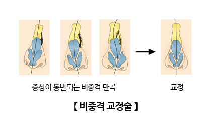 비중격 교정술