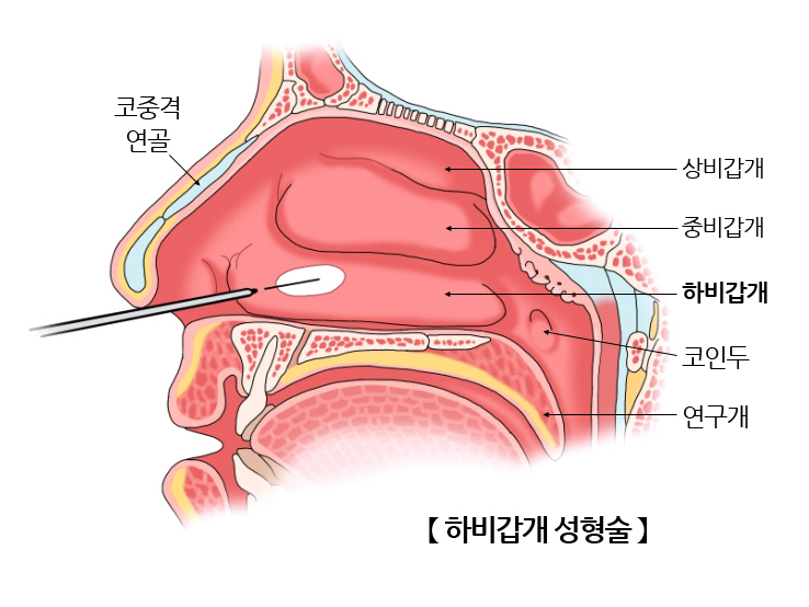 하비갑개 성형술