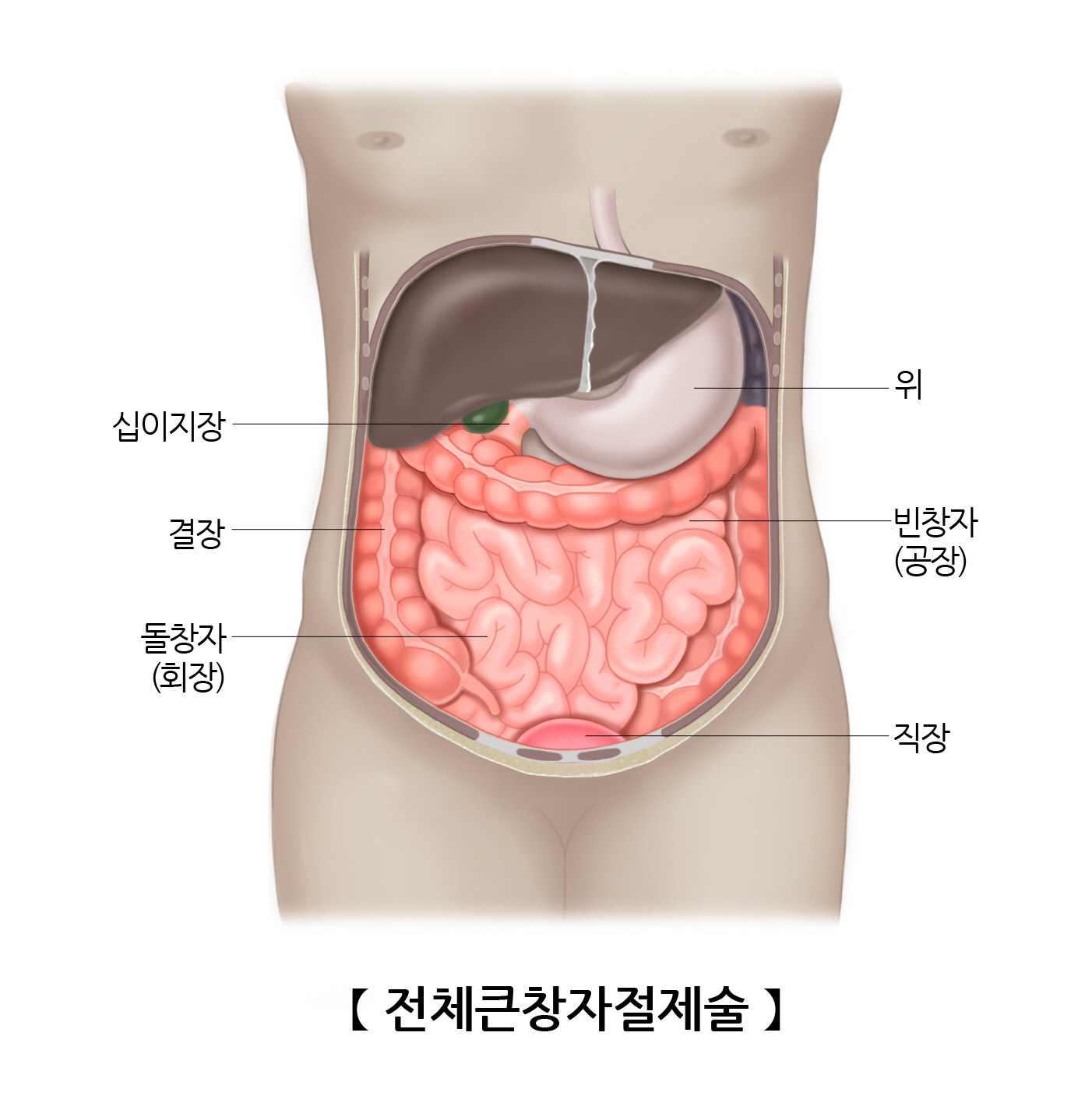 전체대장절제술