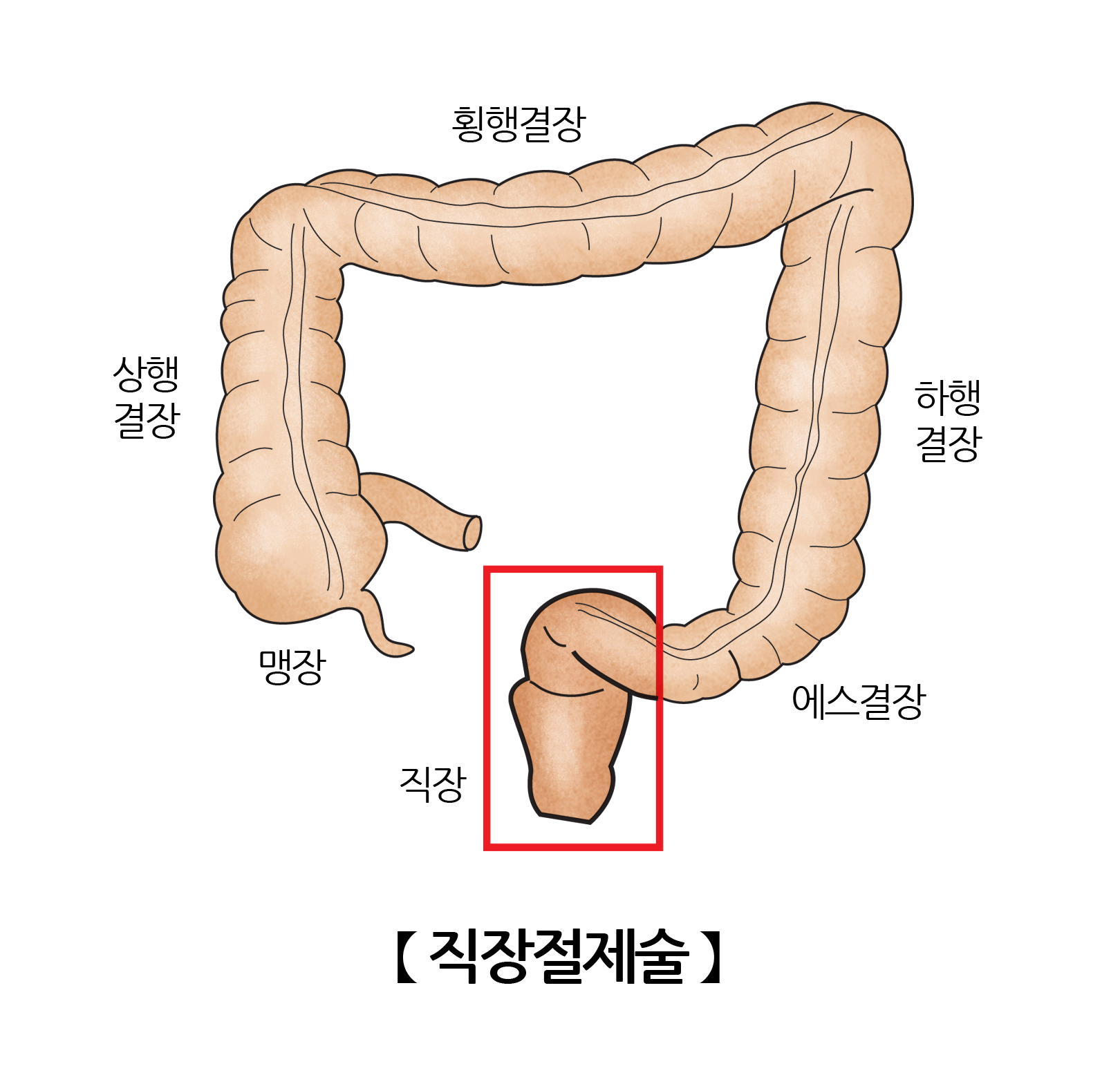 직장절제술