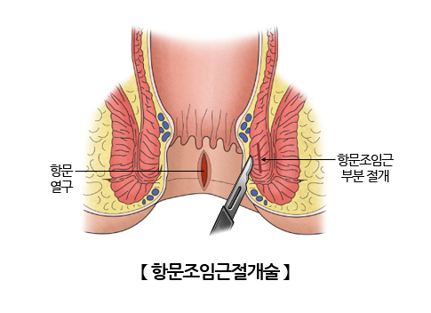 항문조임근절개술